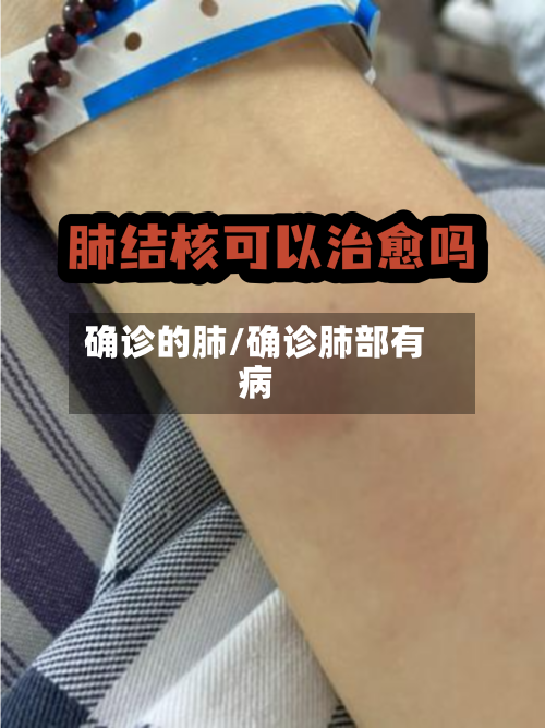 确诊的肺/确诊肺部有病-第3张图片