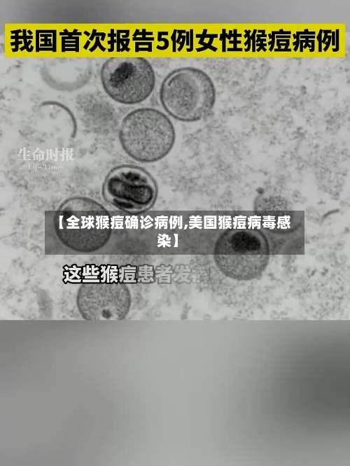 【全球猴痘确诊病例,美国猴痘病毒感染】