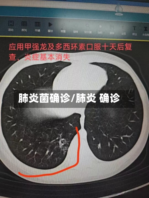 肺炎菌确诊/肺炎 确诊-第3张图片