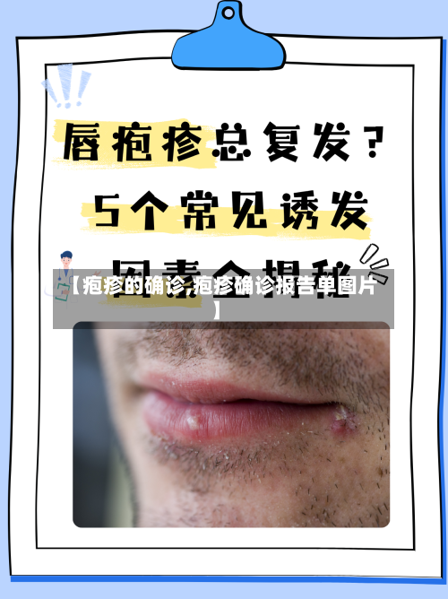 【疱疹的确诊,疱疹确诊报告单图片】