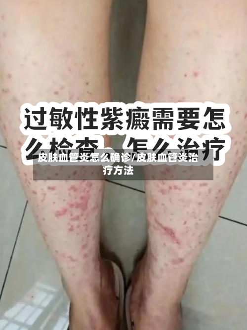 皮肤血管炎怎么确诊/皮肤血管炎治疗方法-第2张图片
