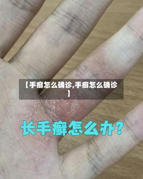 【手癣怎么确诊,手癣怎么确诊】-第2张图片