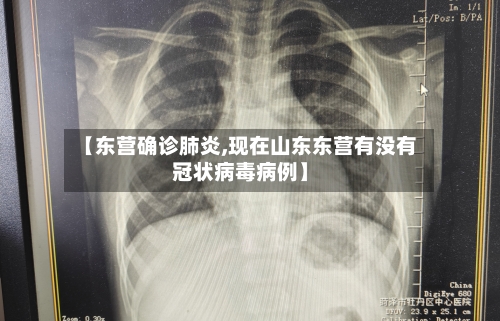 【东营确诊肺炎,现在山东东营有没有冠状病毒病例】-第2张图片