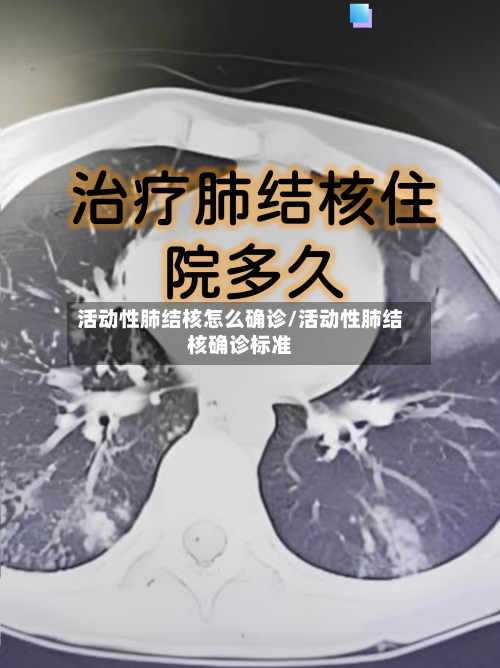 活动性肺结核怎么确诊/活动性肺结核确诊标准