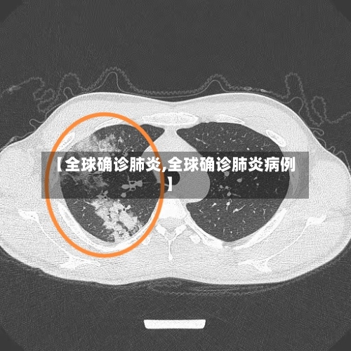 【全球确诊肺炎,全球确诊肺炎病例】-第2张图片