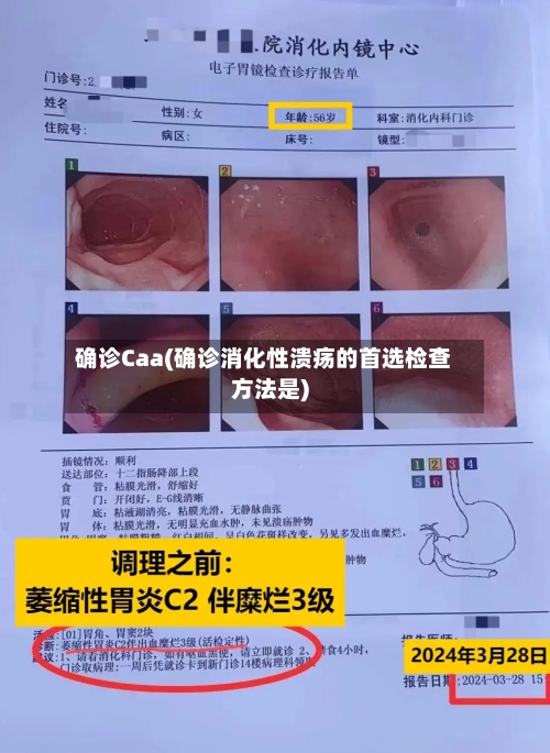 确诊Caa(确诊消化性溃疡的首选检查方法是)-第3张图片