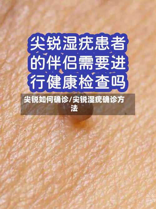 尖锐如何确诊/尖锐湿疣确诊方法