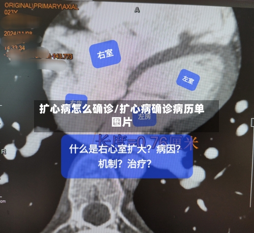 扩心病怎么确诊/扩心病确诊病历单图片-第3张图片