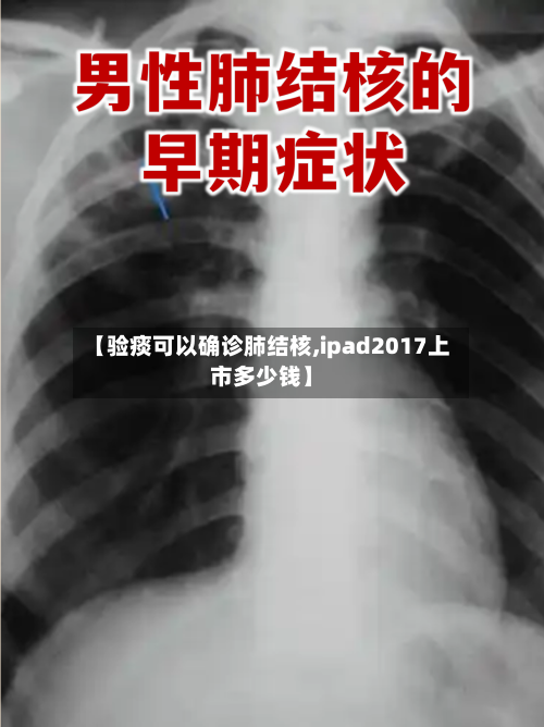 【验痰可以确诊肺结核,ipad2017上市多少钱】