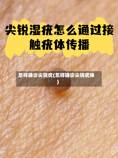 怎样确诊尖锐疣(怎样确诊尖锐疣体)