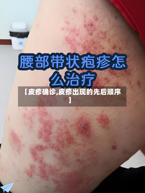 【皮疹确诊,皮疹出现的先后顺序】-第2张图片