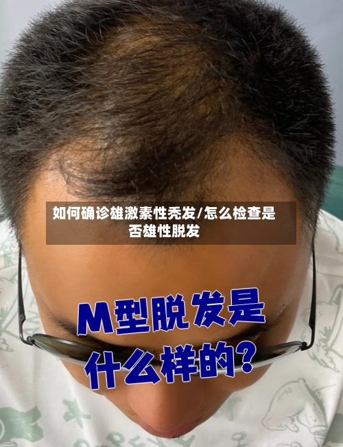 如何确诊雄激素性秃发/怎么检查是否雄性脱发