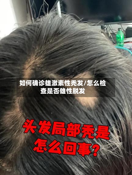 如何确诊雄激素性秃发/怎么检查是否雄性脱发-第2张图片