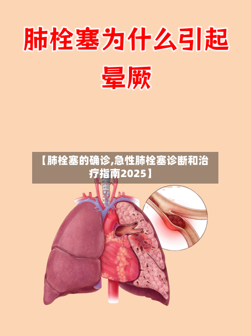 【肺栓塞的确诊,急性肺栓塞诊断和治疗指南2025】