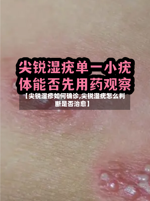 【尖锐湿疹如何确诊,尖锐湿疣怎么判断是否治愈】