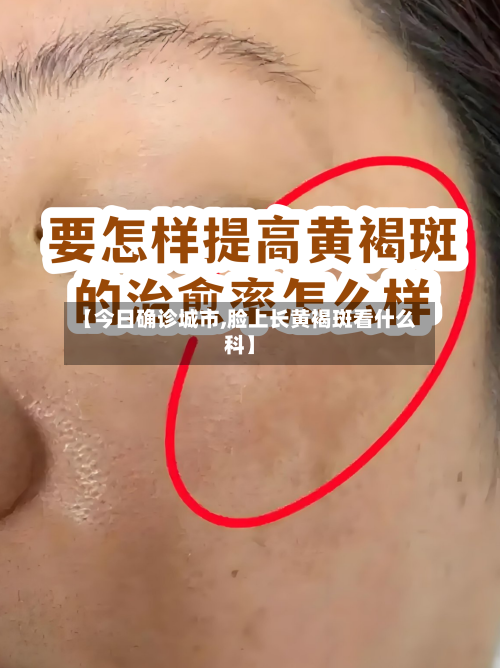 【今日确诊城市,脸上长黄褐斑看什么科】-第2张图片
