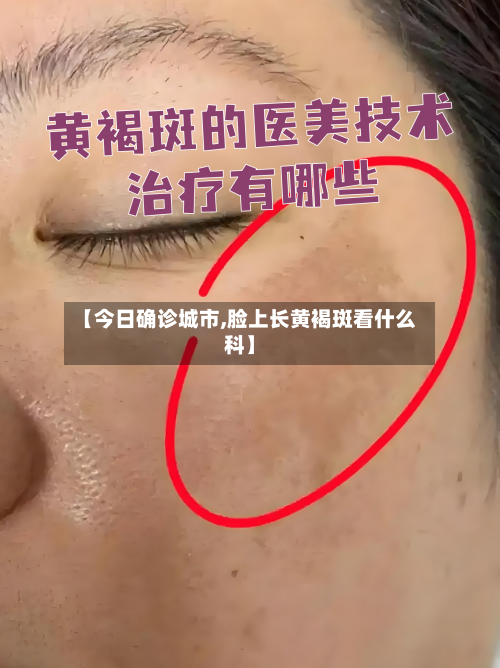 【今日确诊城市,脸上长黄褐斑看什么科】