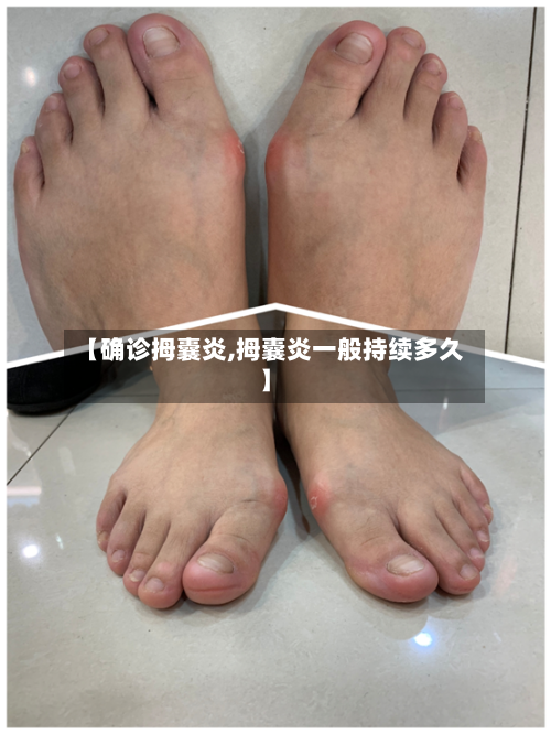 【确诊拇囊炎,拇囊炎一般持续多久】-第2张图片