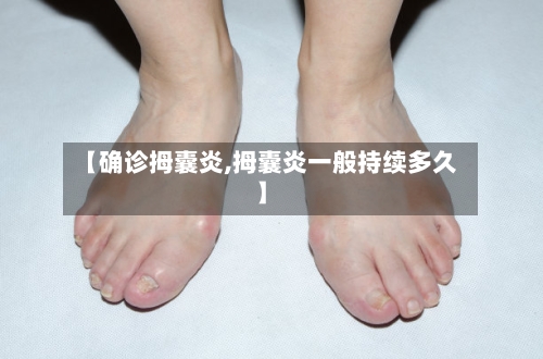 【确诊拇囊炎,拇囊炎一般持续多久】
