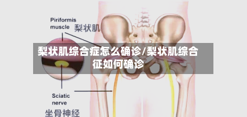 梨状肌综合症怎么确诊/梨状肌综合征如何确诊