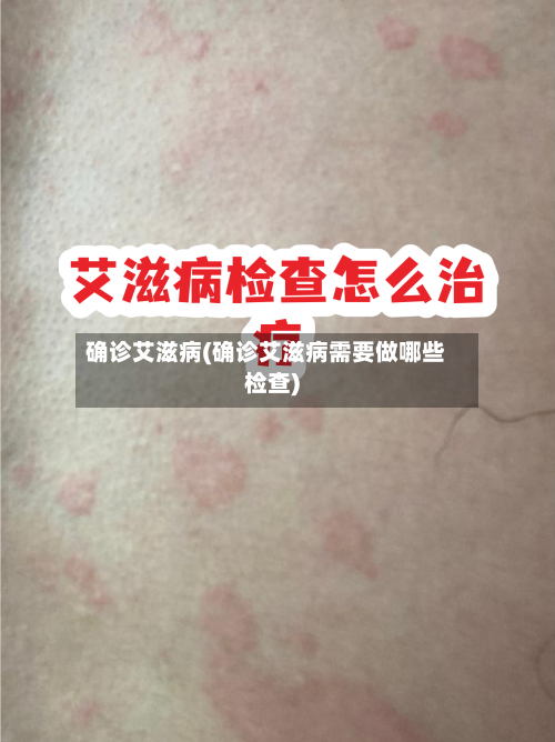 确诊艾滋病(确诊艾滋病需要做哪些检查)-第3张图片