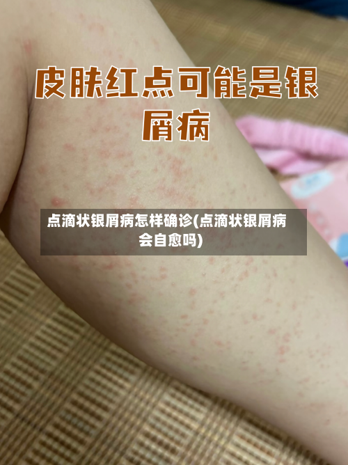 点滴状银屑病怎样确诊(点滴状银屑病会自愈吗)-第2张图片