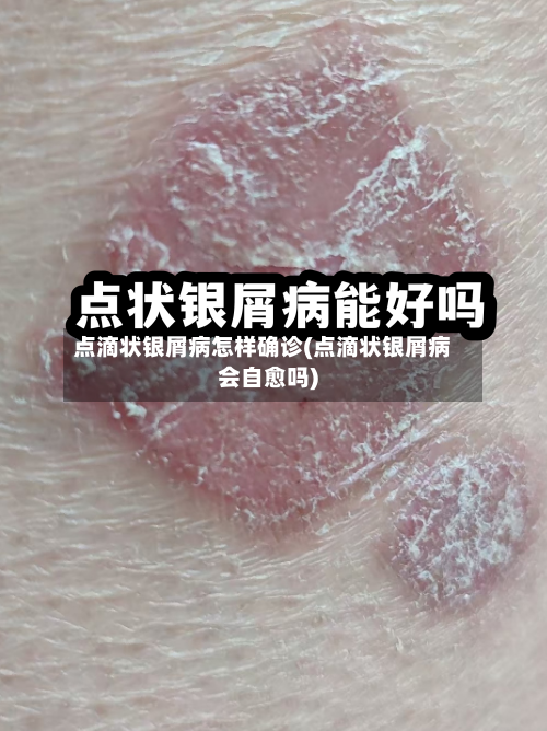 点滴状银屑病怎样确诊(点滴状银屑病会自愈吗)-第3张图片