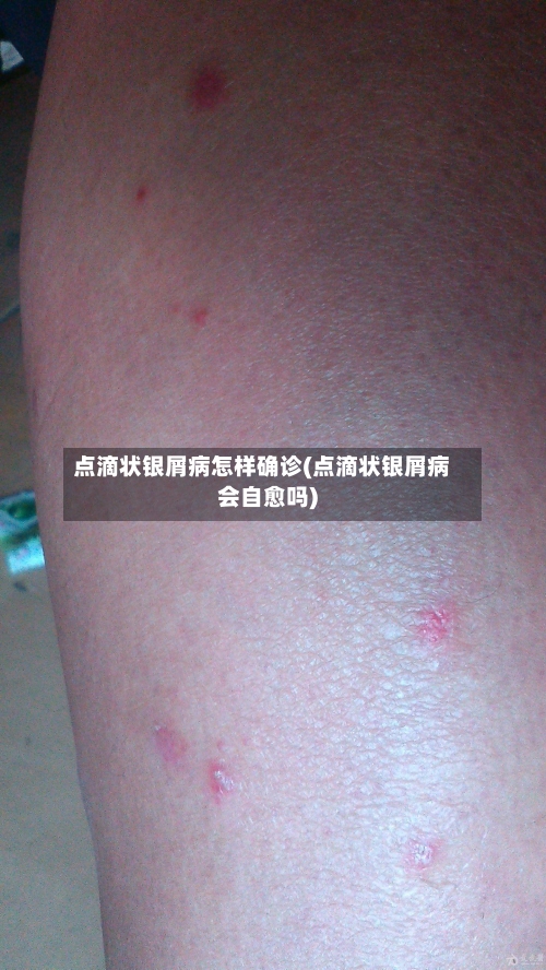 点滴状银屑病怎样确诊(点滴状银屑病会自愈吗)