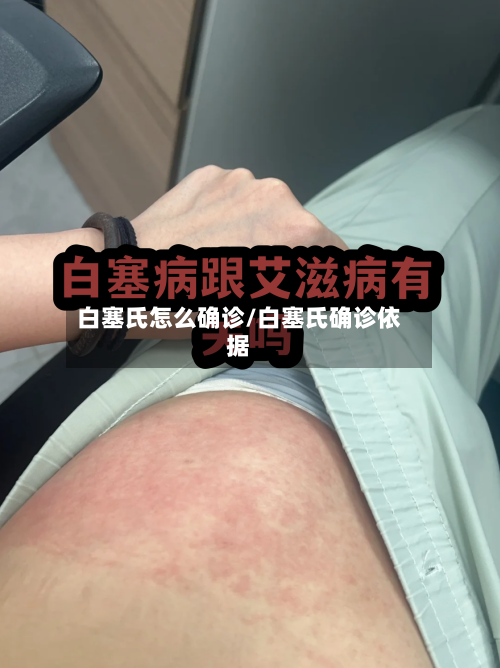 白塞氏怎么确诊/白塞氏确诊依据-第3张图片