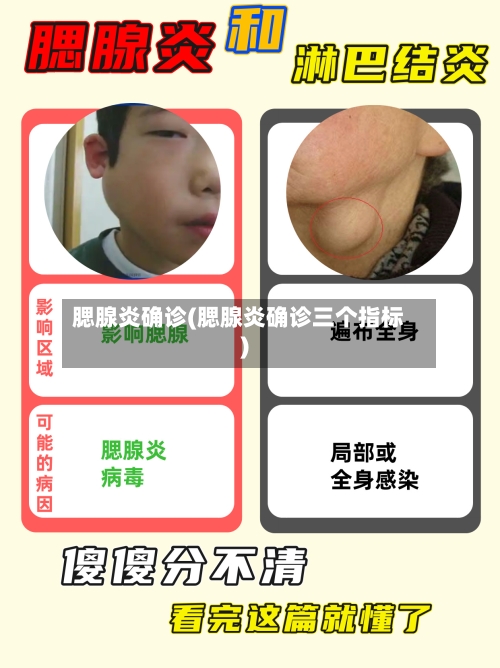 腮腺炎确诊(腮腺炎确诊三个指标)-第3张图片