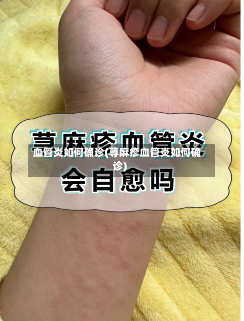 血管炎如何确诊(荨麻疹血管炎如何确诊)