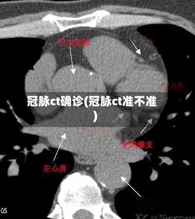 冠脉ct确诊(冠脉ct准不准)