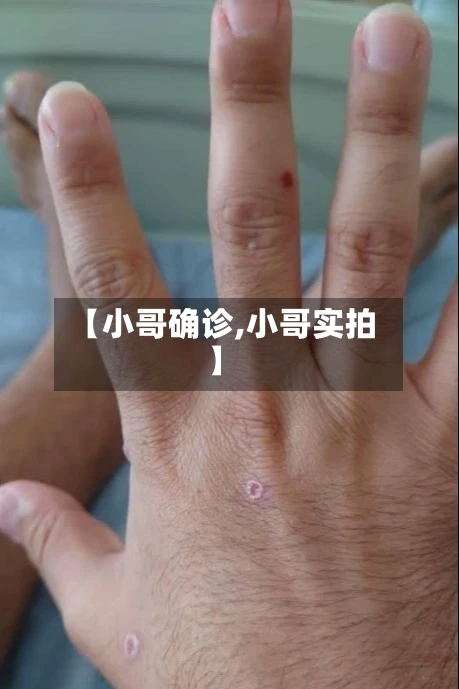【小哥确诊,小哥实拍】