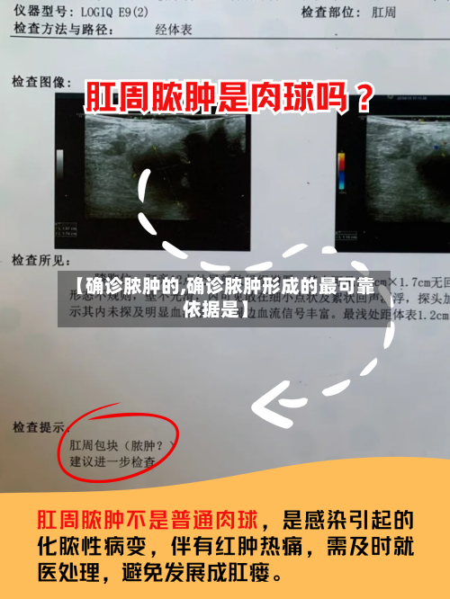 【确诊脓肿的,确诊脓肿形成的最可靠依据是】