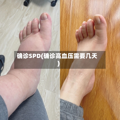 确诊SPD(确诊高血压需要几天)-第2张图片