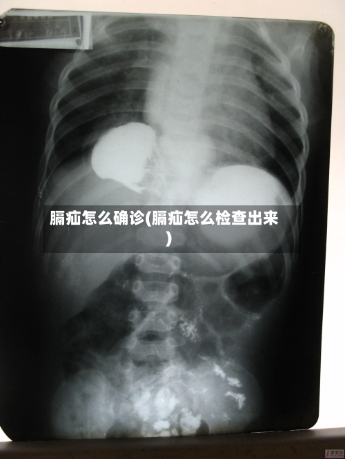 膈疝怎么确诊(膈疝怎么检查出来)-第2张图片