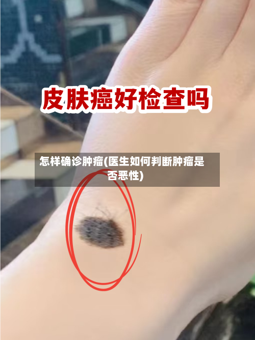 怎样确诊肿瘤(医生如何判断肿瘤是否恶性)-第2张图片