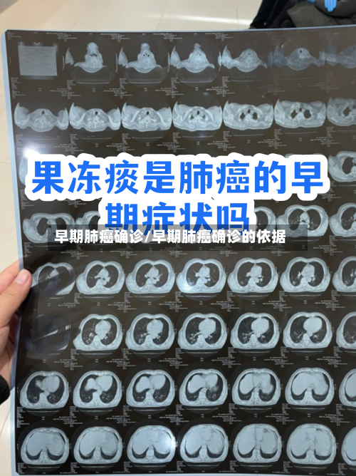 早期肺癌确诊/早期肺癌确诊的依据-第3张图片