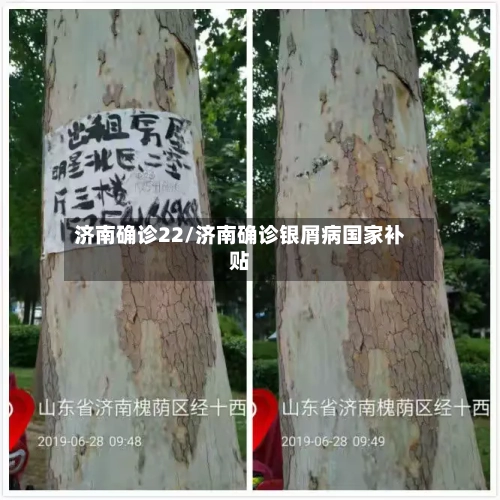 济南确诊22/济南确诊银屑病国家补贴