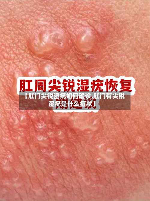 【肛门尖锐湿疣如何确诊,肛门有尖锐湿疣是什么症状】