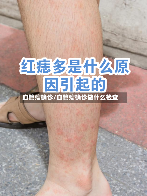 血管瘤确诊/血管瘤确诊做什么检查