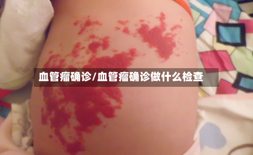 血管瘤确诊/血管瘤确诊做什么检查-第2张图片