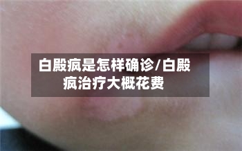 白殿疯是怎样确诊/白殿疯治疗大概花费