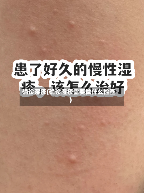 确诊湿疹(确诊湿疹需要做什么检查)-第2张图片