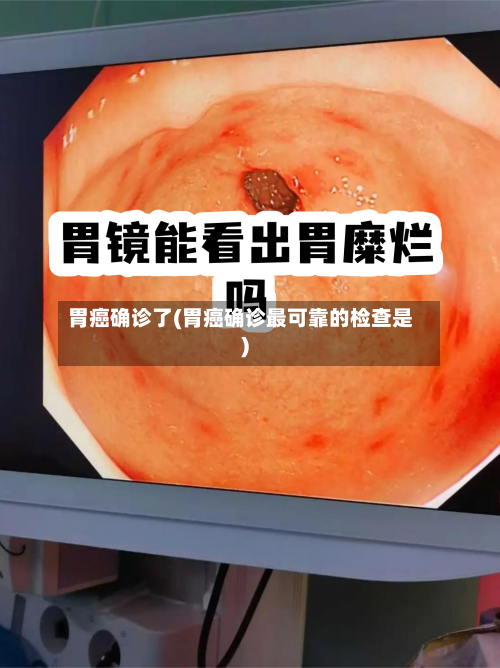 胃癌确诊了(胃癌确诊最可靠的检查是)-第2张图片