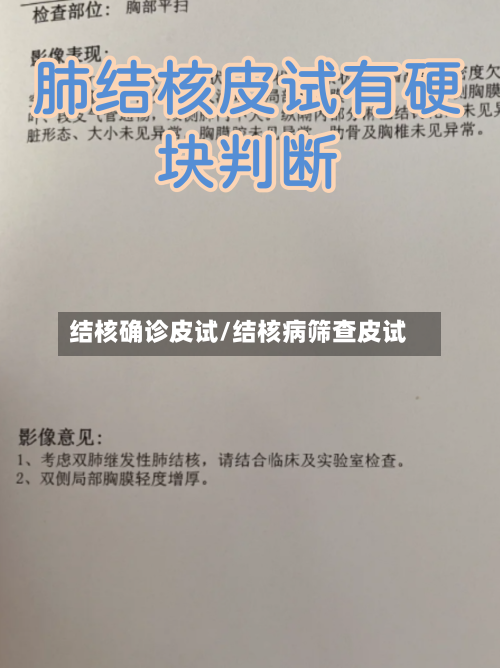 结核确诊皮试/结核病筛查皮试