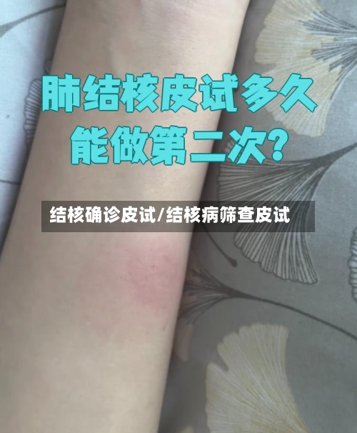 结核确诊皮试/结核病筛查皮试-第3张图片