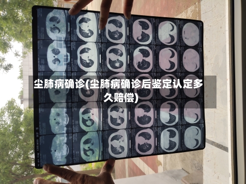 尘肺病确诊(尘肺病确诊后鉴定认定多久赔偿)