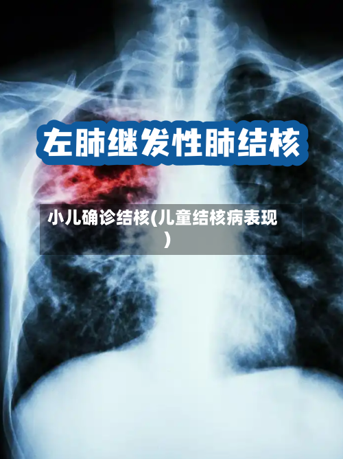 小儿确诊结核(儿童结核病表现)-第2张图片