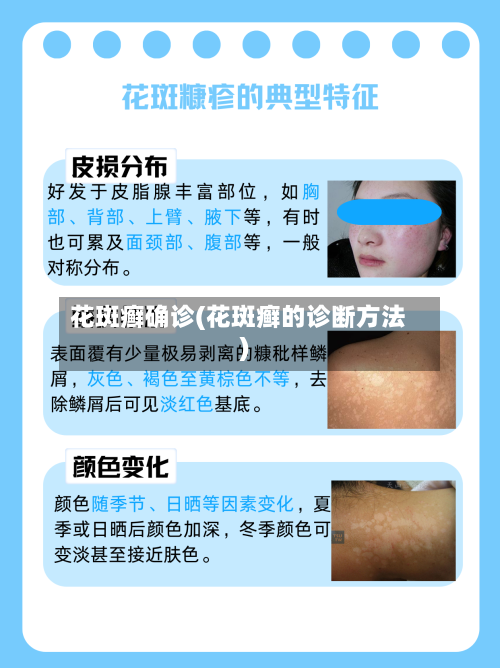 花斑癣确诊(花斑癣的诊断方法)